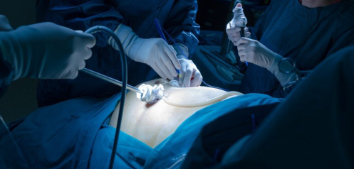 Bariatric Surgery: Is It Right for You?